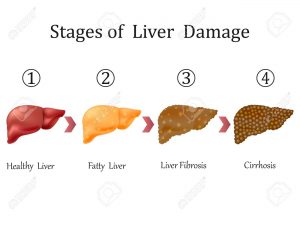 Fatty Liver and Lipotropic factors – Biochemistry Basics by Dr. Amit ...